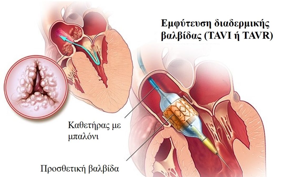Διαδερμική αντικατάσταση αορτικής βαλβίδας (TAVI)
