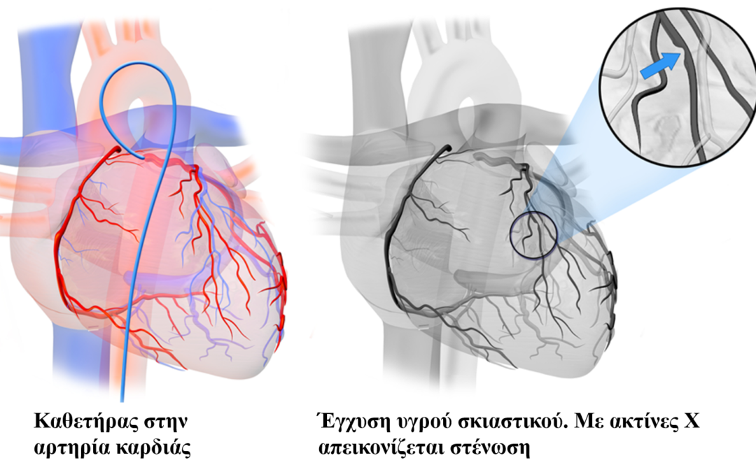 Στεφανιογραφία και αγγειοπλαστική